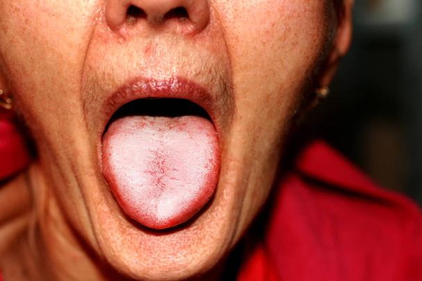 Die Zunge ist in einem weißen Raub. Candidiasis auf der Zunge - Foto, Bild