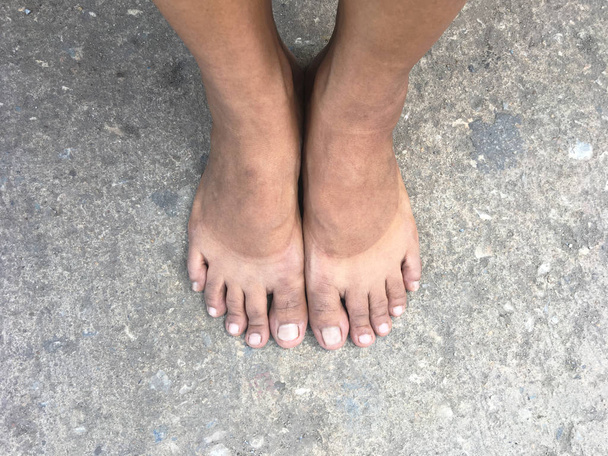 Σήμα του ηλιακού εγκαύματος με γυμνά τα πόδια μετά την απογείωση παπούτσια. - Φωτογραφία, εικόνα