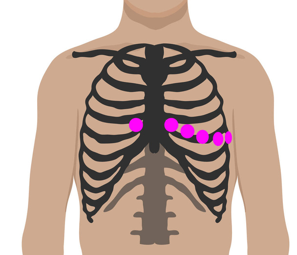 Chest leads placement. Ecg electrode position - Vector, Image