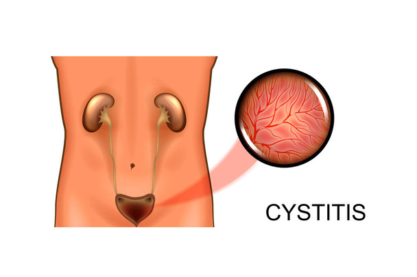 ουροποιητικό σύστημα. κυστίτιδα - Διάνυσμα, εικόνα
