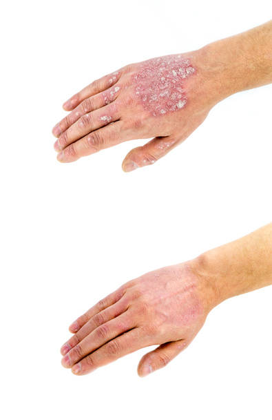 Psoriasis vulgaris auf der Hand, vor und nach der Behandlung, isoliert auf weißem Hintergrund. Nahaufnahme. - Foto, Bild
