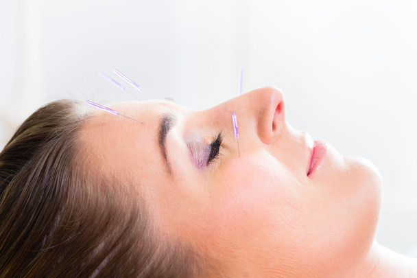 Mujer en acupuntura con agujas en la cara
 - Foto, Imagen