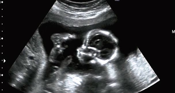 Análisis ultrasonográfico de un feto de cuarto mes, Italia - Foto, imagen