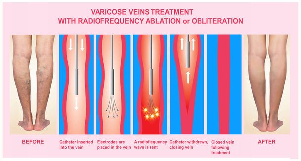 Varices et traitement par ablation radiofréquence
 - Photo, image