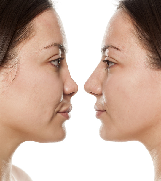 Perfil da mulher, antes e depois da cirurgia nasal
 - Foto, Imagem