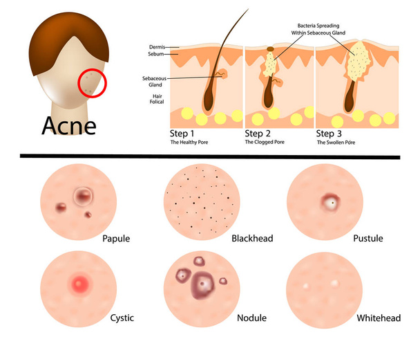 Různé typy akné ilustrace / akné fáze. Infografika - Vektor, obrázek