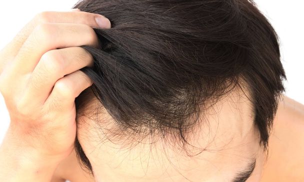 Fiatal férfi súlyos hajhullás probléma az egészségügyi ellátás orvosi és sampon termék koncepció - Fotó, kép