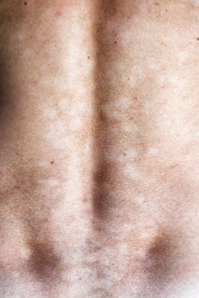 Moly versicolor - pityriasis versicolor - gombás fertőzés a bőr. - Fotó, kép