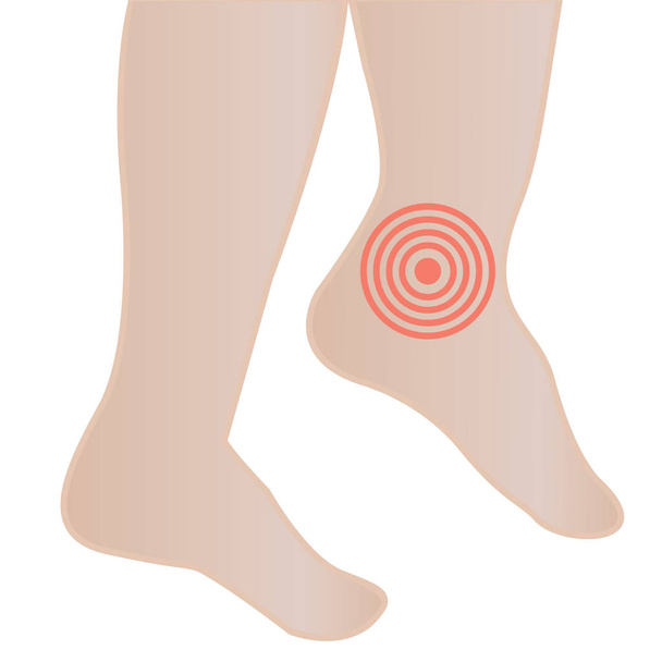 Jalkojen ja nilkkojen turvotus tartunnan tai vamman seurauksena - Vektori, kuva