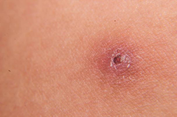 Macro image of skin with lesion - Photo, Image