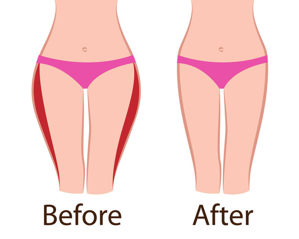 Fat and slim  girls' hips. Before and after.   - Vector, Image