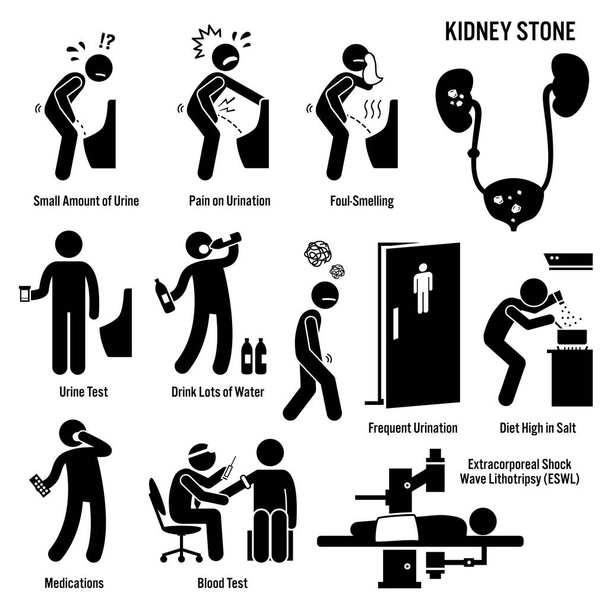 Kidney Stone Icons. Pictogram and diagrams depict signs, symptoms, diagnosis, and treatment of kidney stones.  - Vector, Image