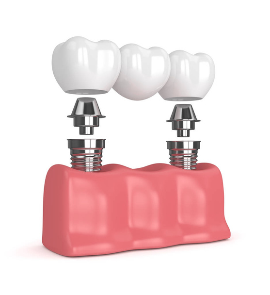 3d render of implants with dental bridge  - Fotó, kép