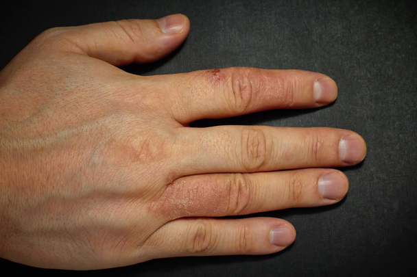 Dermatite de la main. Eczéma des mains
 - Photo, image