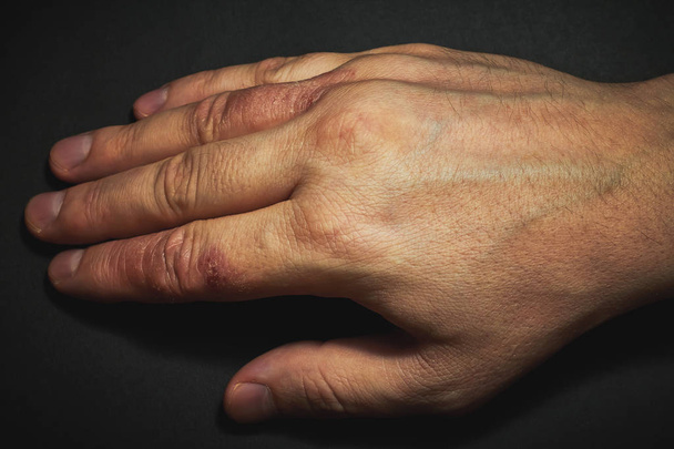 Hand dermatitis. Hand eczeem - Foto, afbeelding