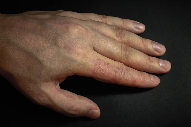 Dermatitida rukou. Ekzém na rukou - Fotografie, Obrázek