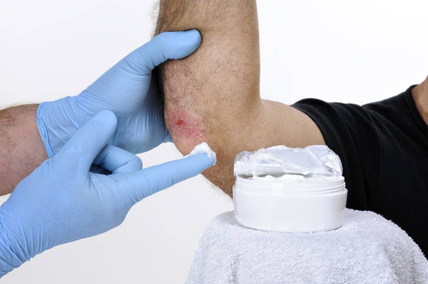 Dermatolog leczy dojrzałego mężczyzny z łokcia psorias - Zdjęcie, obraz