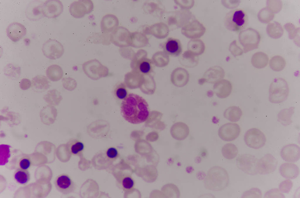 Blood smear Thalassemia patient. - Photo, Image