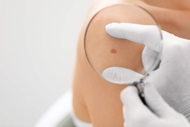 Dermatologist examining birthmark of patient, closeup. Cancer concept - Photo, image