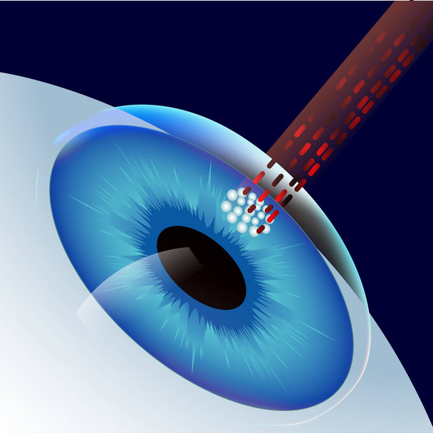Лазерний очей корекції
 - Вектор, зображення