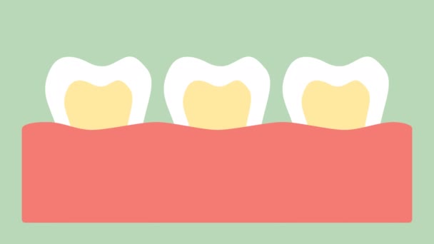 stages of tooth decay or dental caries - teeth cartoon vector flat style render 2d footage animation, in 4K and UHD ultra high definition video format 3840x2160 - Footage, Video