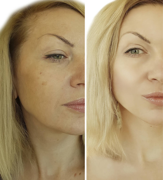 arrugas de la cara de mujer antes y después
 - Foto, Imagen