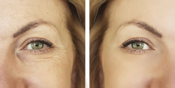 kadın yüz kırışıklıklar önce ve sonra - Fotoğraf, Görsel