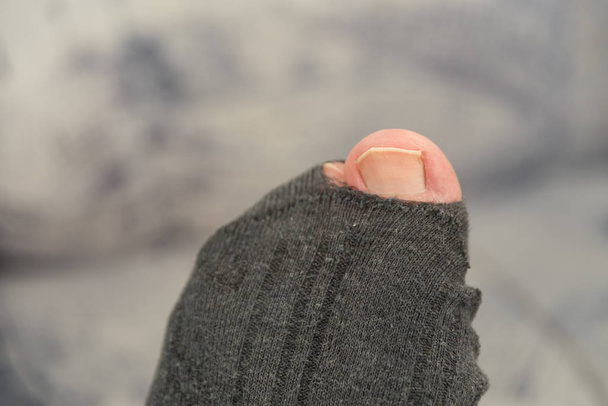 dedo gordo del pie - agujero en el calcetín
 - Foto, imagen