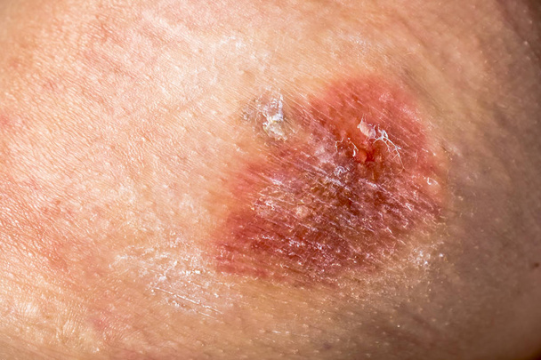 Gros plan sur les brûlures chimiques sur la peau avec une goutte de liquide douloureux et des résidus de crème
 - Photo, image