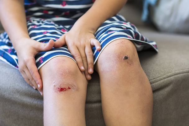 Κοντινό πλάνο του κοριτσάκι που κρατάει το μελανιασμένο τραυματισμένο γόνατο είναι κατεστραμμένο με τα χέρια - Φωτογραφία, εικόνα