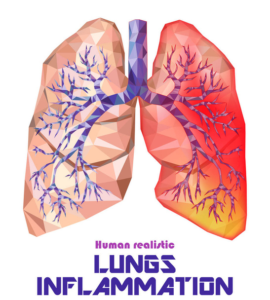 Low poly realistic human lungs and bronchus with cancer inflamma - Vector, Image