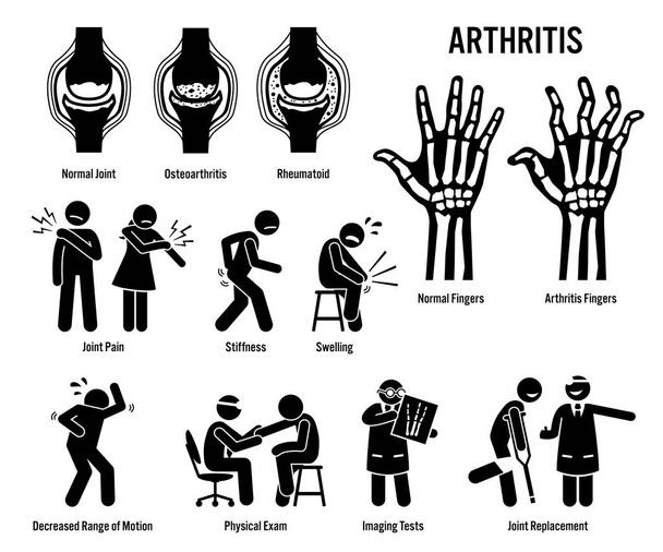 Artrite, dolore articolare e icone delle malattie articolari. Pittogrammi raffigurano segni di artrite, sintomi, diagnosi e trattamento. Le icone includono ossa per l'osteoartrite e l'artrite reumatoide
. - Vettoriali, immagini