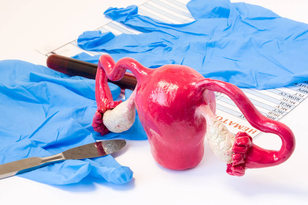 Έννοια των γεννητικών οργάνων γυναικών χειρουργική μήτρα και τις ωοθήκες. Μοντέλο της μήτρα και τις ωοθήκες κοντά νυστέρι, χειρουργικά γάντια και αίμα δοκιμαστικό σωλήνα με αποτέλεσμα στο αίμα. Ενδείξεις για χειρουργική επέμβαση ή χειρουργική επέμβαση - Φωτογραφία, εικόνα