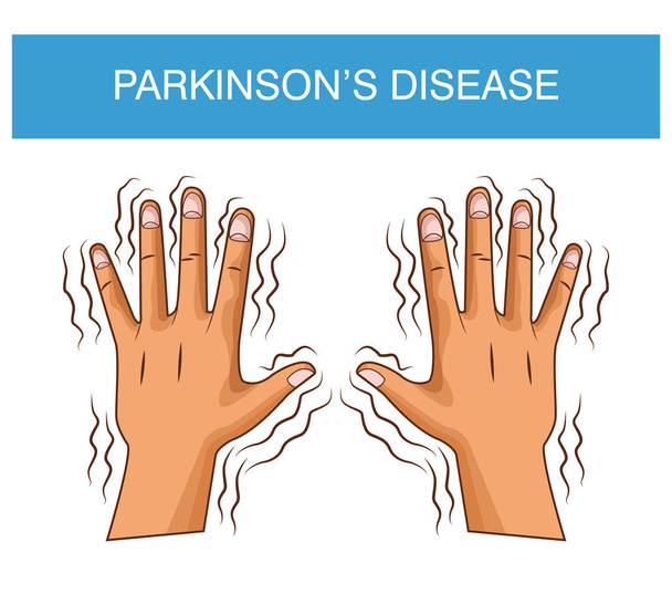 Parkinsonovy choroby kreslený - Vektor, obrázek