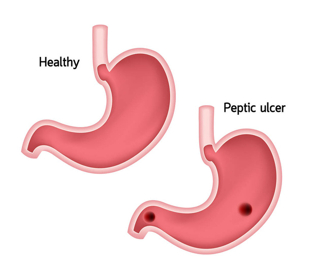 健康的な胃の比較および潰瘍。ヒトの胃の衛生、白い背景で隔離のベクトル図 - ベクター画像