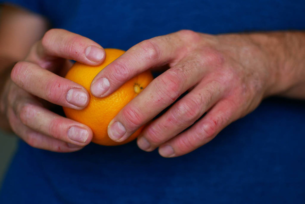 The man has psoriasis. Allergy to citrus. Close-up of hands. - Zdjęcie, obraz
