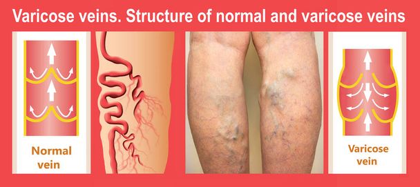 Venas varicosas en una pierna mayor femenina
 - Foto, Imagen