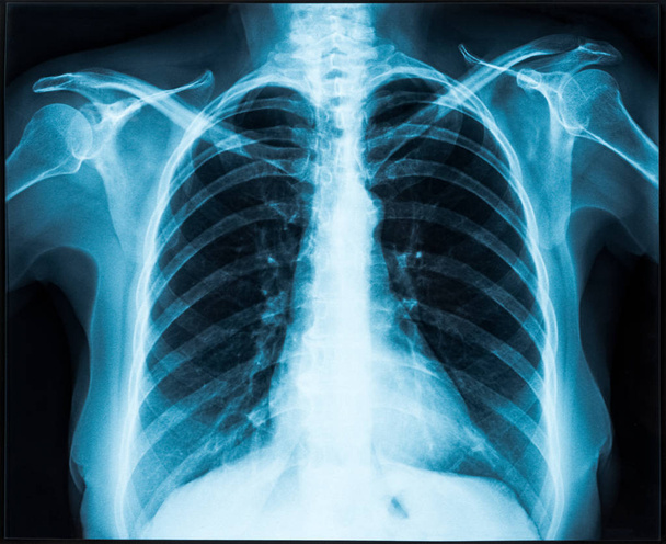 raio-X do tórax
 - Foto, Imagem