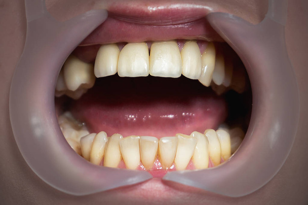 Mund mit vier prothetischen oberen Zähnen - Foto, Bild