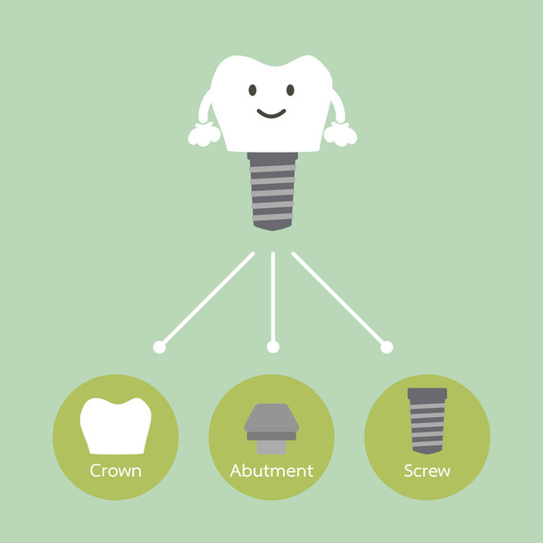 struktura zubní implantát s všechny části rozebrán, koruny, opěrné, šroub - Vektor, obrázek