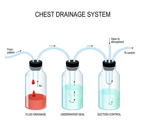 Chest drainage system - Vector, Image