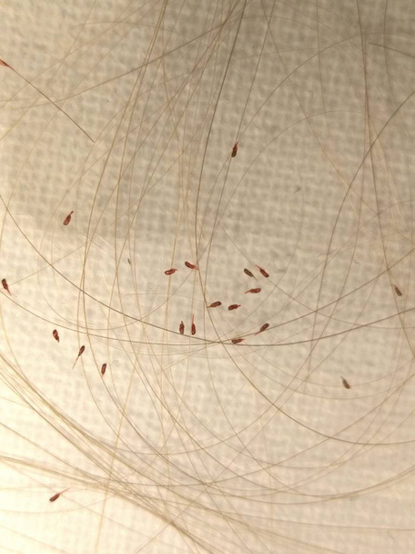 Head lice (louses) isolated - Fotoğraf, Görsel