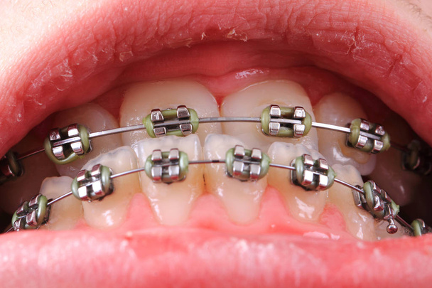 braces in the young mouth - Photo, Image