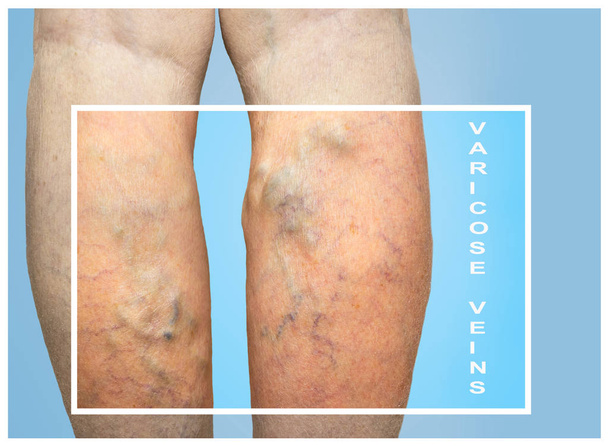 Venas varicosas en piernas femeninas
 - Foto, Imagen