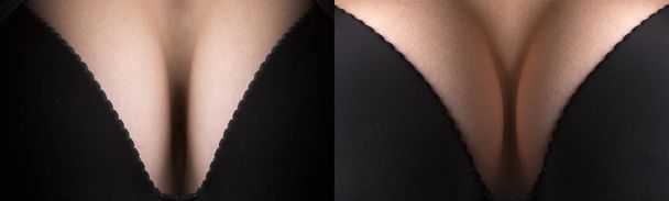 豊胸術、胸の整形手術、手術後の女性の胸の大きなサイズが増加します。美容外科、乳前に、と後.黒ブラジャーやランジェリー。セクシーな女性サイズ シリコーン - 写真・画像