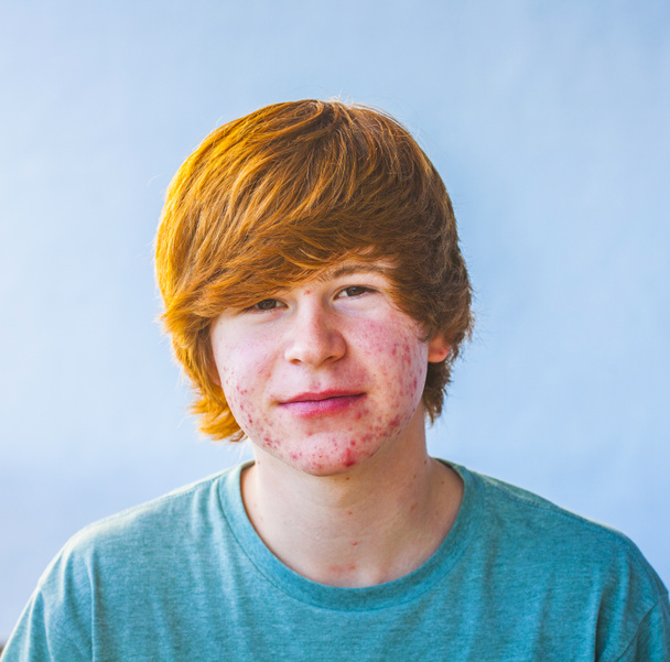 menino inteligente na puberdade com acne
 - Foto, Imagem