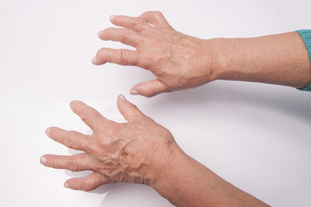 τα χέρια με ρευματοειδή αρθρίτιδα - Φωτογραφία, εικόνα