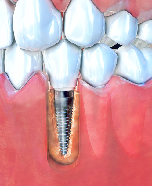 3D illustratie van een tandheelkundig implantaat in de onderkaak - Foto, afbeelding