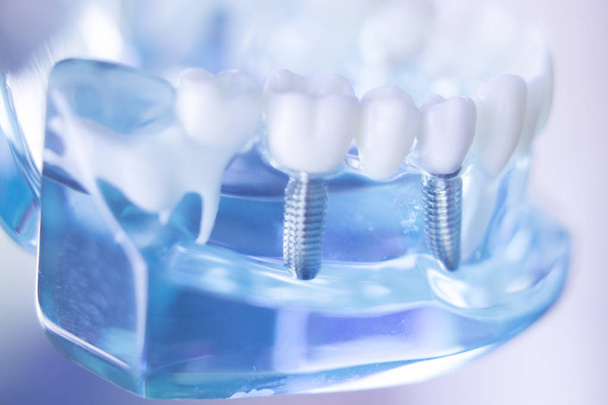 Стоматологічна імплантація зубів
 - Фото, зображення