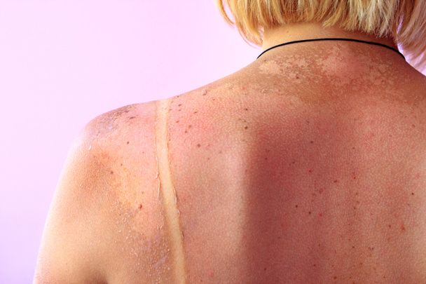 Sporen van zonnebrand op de achterkant van een vrouw. Vrouwelijk lichaam - Foto, afbeelding